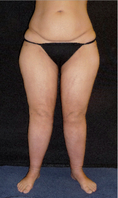 After liposuction of 9200ml in three sessions
