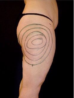 Präoperative gekennzeichnete Absaugareale Präoperative gekennzeichnete Absaugareale