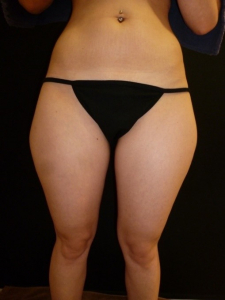 29jährige Patientin am nächsten Morgen nach der Liposuktion der Oberschenkel außen, der Oberschenkel innen und der Knie innen