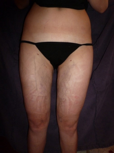 29jährige Patientin am nächsten Morgen nach der Liposuktion der Oberschenkel außen, der Oberschenkel innen und der Knie innen